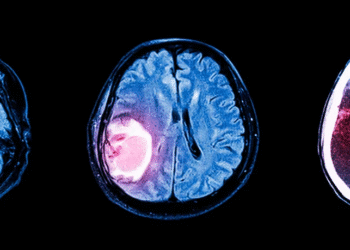 Fármaco para presión arterial podría frenar el crecimiento de tumores cerebrales