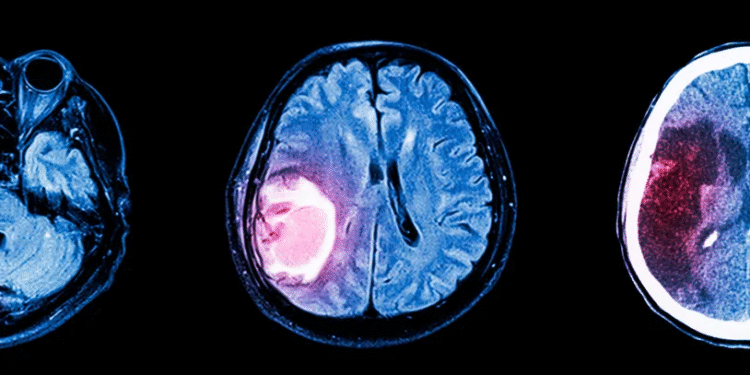 Fármaco para presión arterial podría frenar el crecimiento de tumores cerebrales