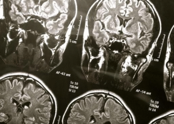 Científicos revelan que colesterol podría ser el «héroe» del cerebro