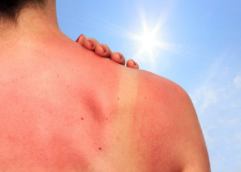 Cómo aliviar las quemaduras de sol con este líquido que tienes en la cocina
