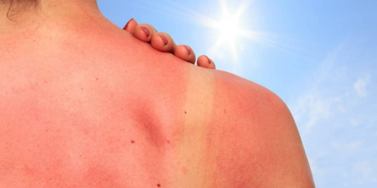 Cómo aliviar las quemaduras de sol con este líquido que tienes en la cocina