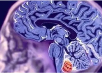 Científicos dicen que el autismo puede ser el resultado de la evolución biológica del cerebro humano