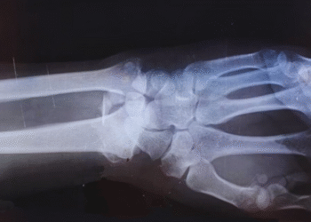 China desenvolve produto para colar ossos quebrados em 3 minutos sem cirurgia