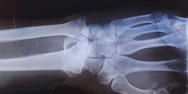 China desenvolve produto para colar ossos quebrados em 3 minutos sem cirurgia