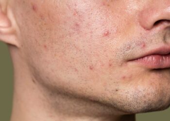 Aracnídeo Demodex vive no seu rosto, principalmente em pele sebosa