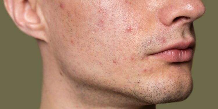 Aracnídeo Demodex vive no seu rosto, principalmente em pele sebosa