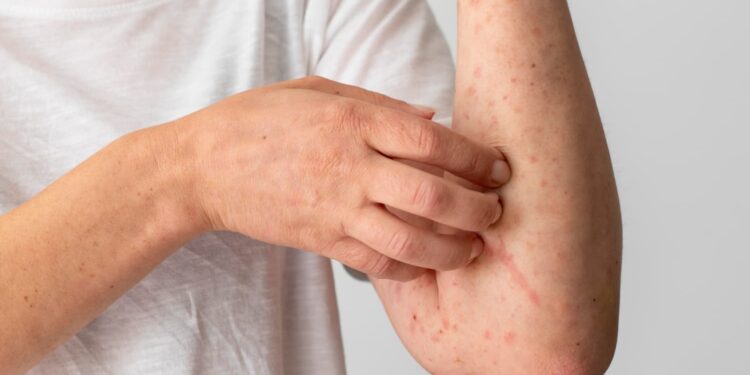 Sarampo volta a assustar população e exige alerta para o risco de contaminação