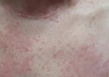 Surto de sarna humana deixa moradores de cidade brasileira em alerta máximo