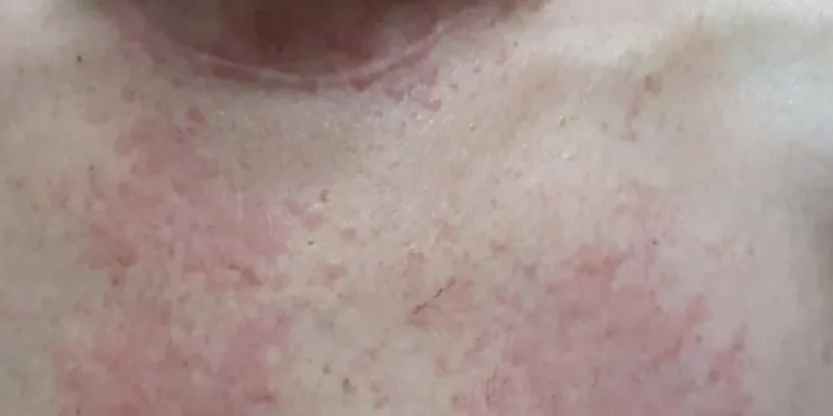 Surto de sarna humana deixa moradores de cidade brasileira em alerta máximo