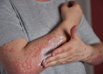 Como surge a catapora e quais meios de tratamento podem ser usados