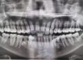 Homem achava ter 38 dentes, foram encontrados mais 4 e ele entrou para o Guinness Book