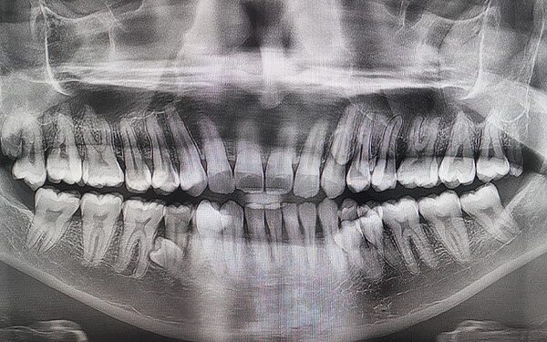 Homem achava ter 38 dentes, foram encontrados mais 4 e ele entrou para o Guinness Book